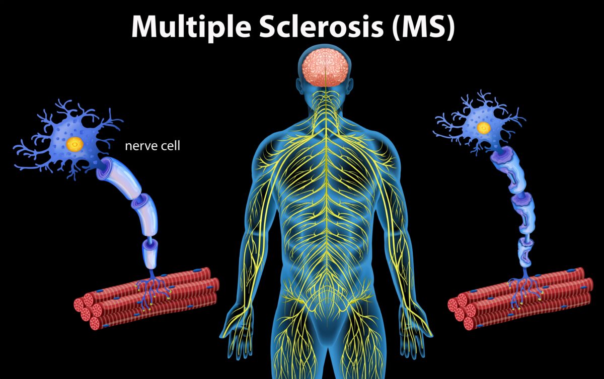 Multiple sclerosis: a fat metabolysm disorder?