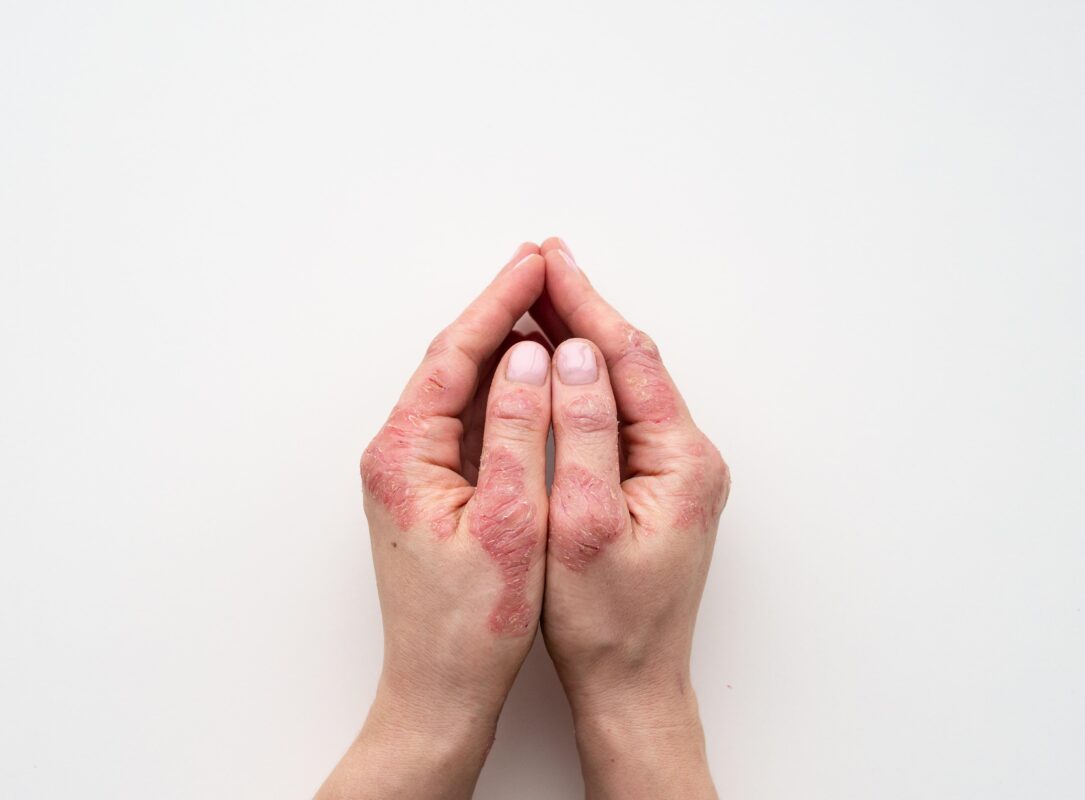 Psoriasis